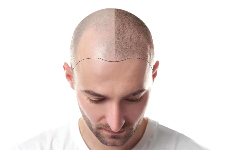 Hair Transplantation