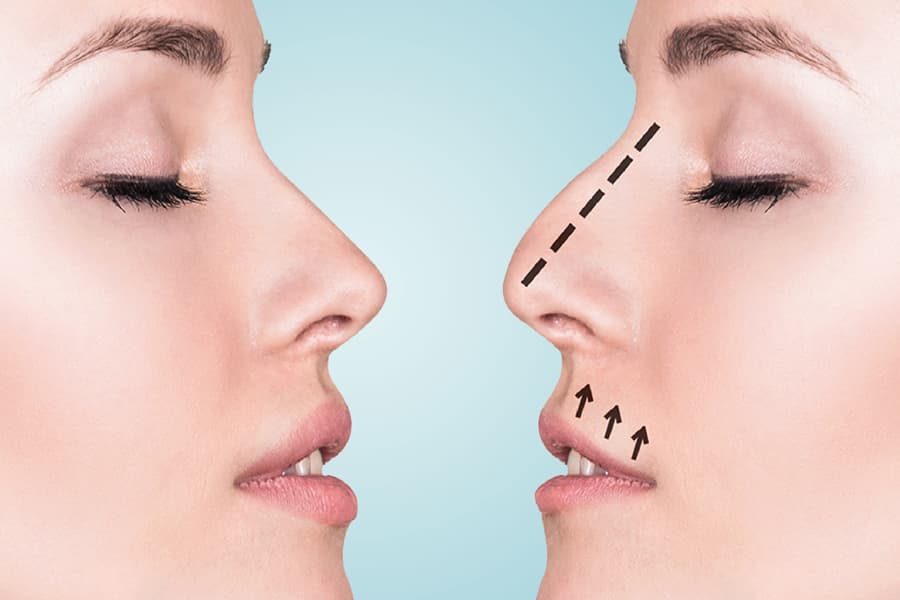 Rhinoplasty Operation