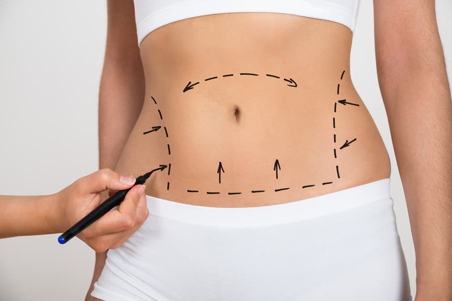 Tummy Tuck Operation